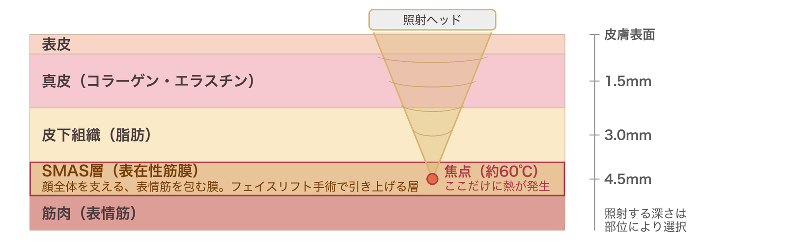 皮膚の断面図。表皮・真皮・皮下組織・SMAS層・筋肉の位置と、照射の深さ1.5mm/3.0mm/4.5mmを示した図