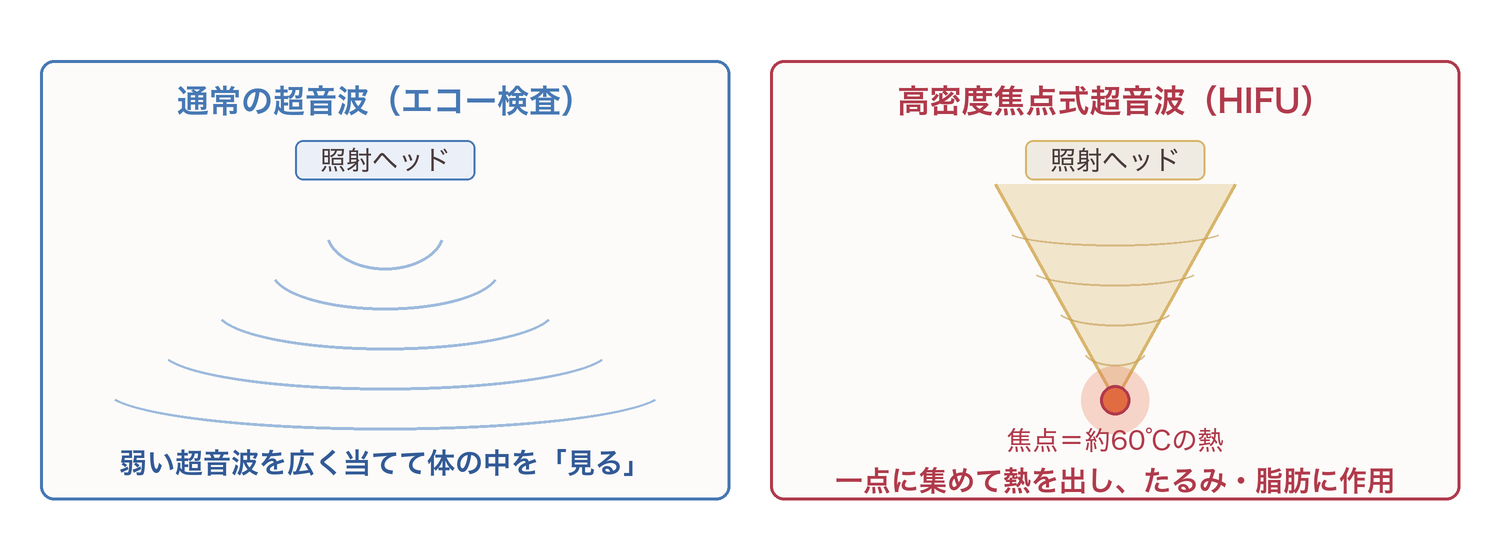 通常の超音波（エコー検査）と高密度焦点式超音波（HIFU）の違いを示した図